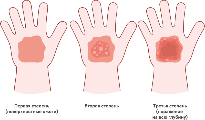 Ожоговая болезнь у детей
