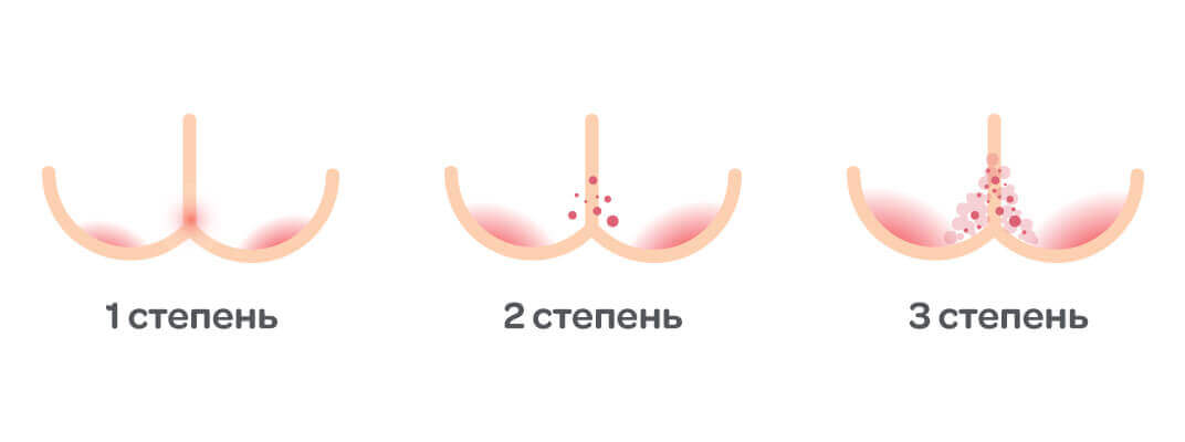 Опрелости у новорожденных и как с ними бороться