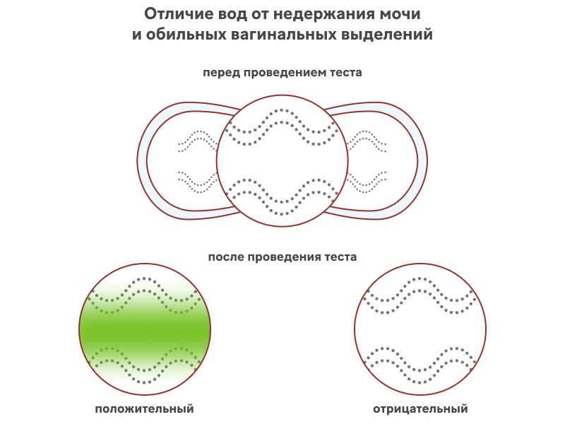 Как выглядит подтекание околоплодных вод?