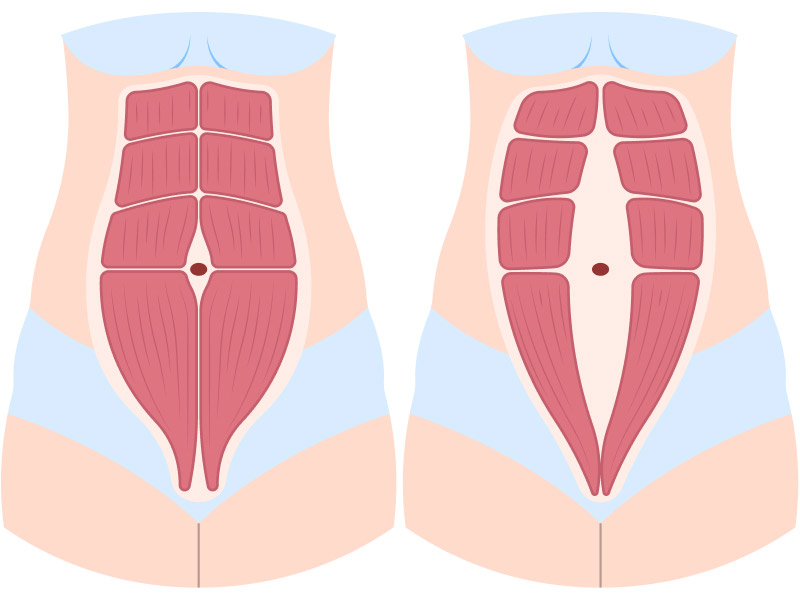 Как понять, есть у ли вас диастаз