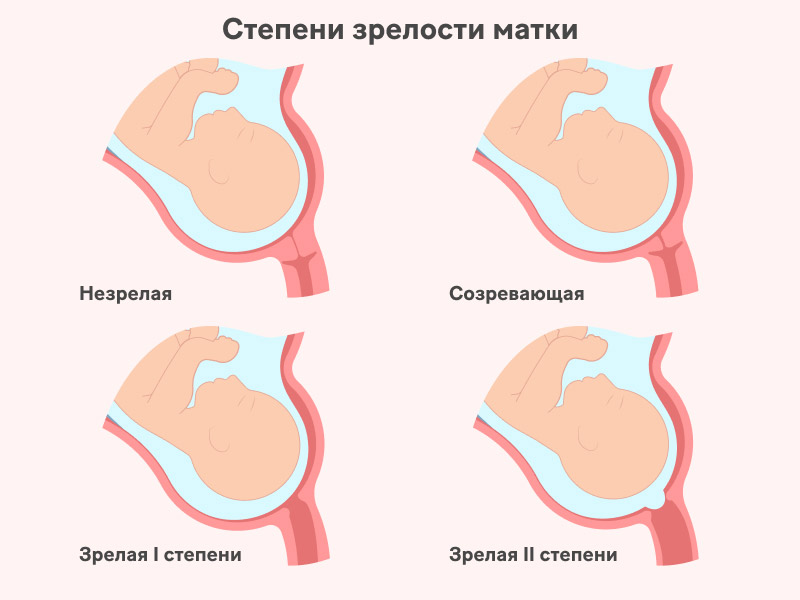 Что такое раскрытие шейки матки перед родами?