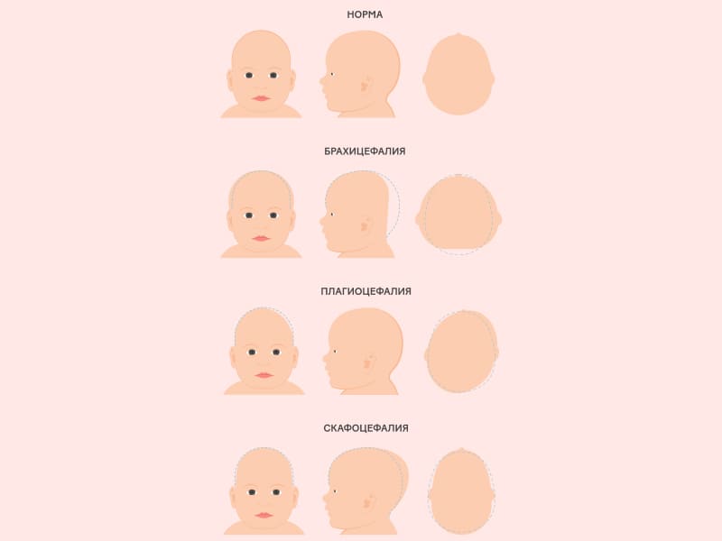 Форма головы новорожденного