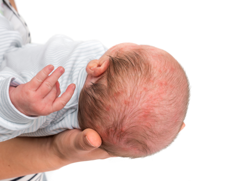 Почему у новорожденных появляется акне?